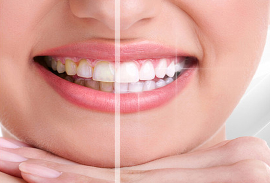 Blanqueamiento Laser