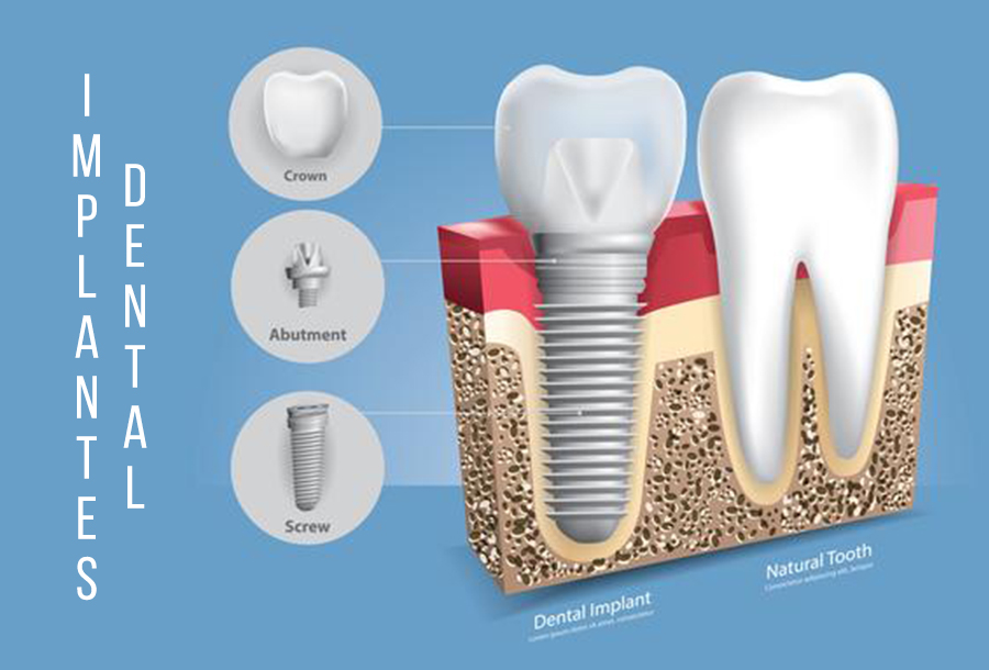 Implantes Dentales