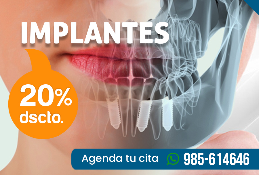 Oferta de Implantes Dentales