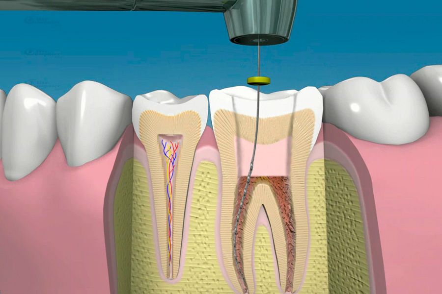 Endodoncia