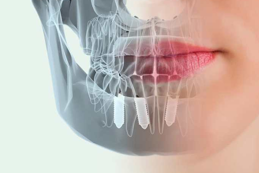 Implantes Dentales